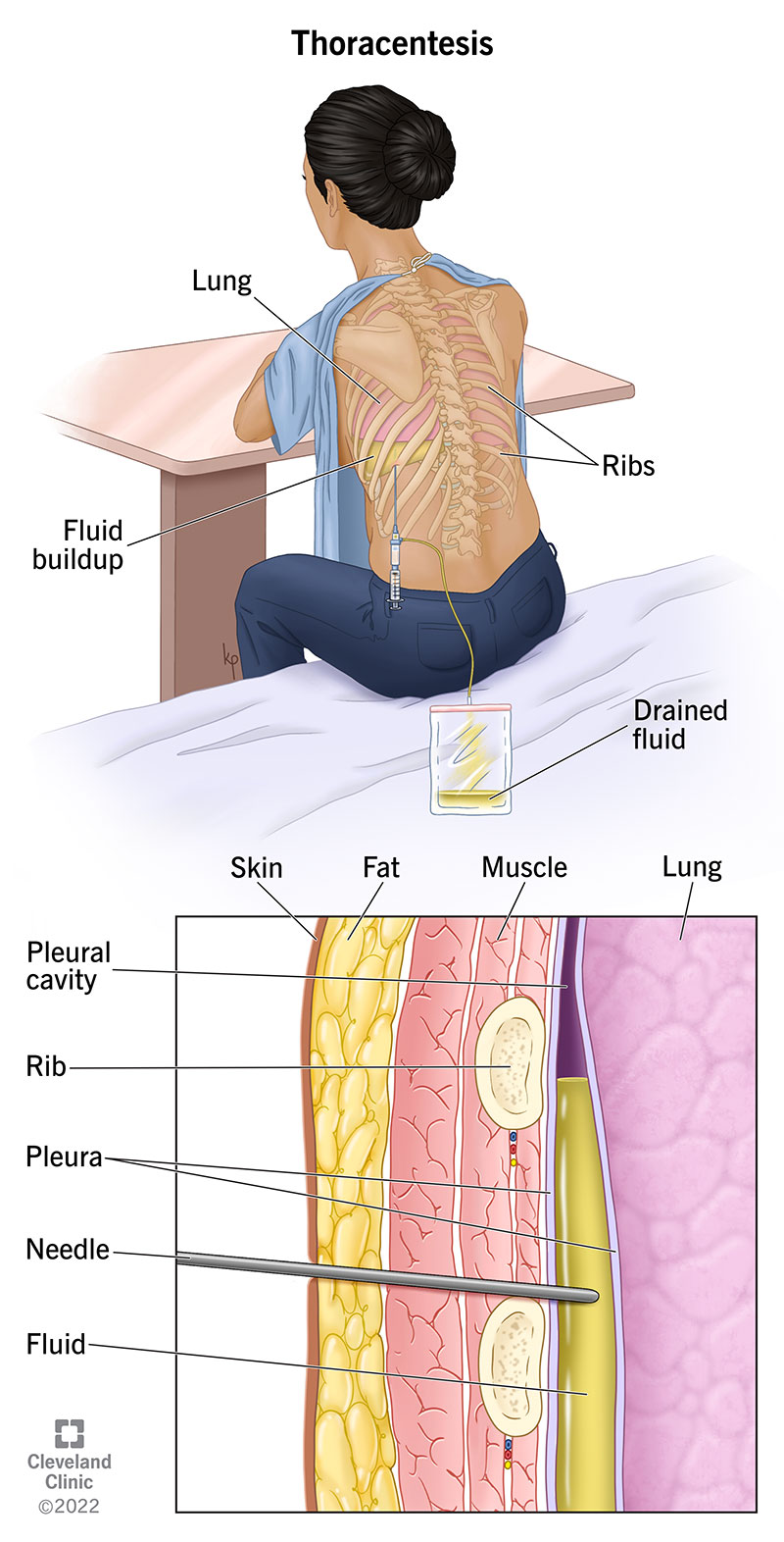 thoracentesis procedure steps