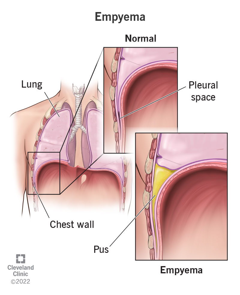 Your pleural space is a hollow, empty cavity between your lungs and underneath your chest. If you have empyema, the space fills with pus.