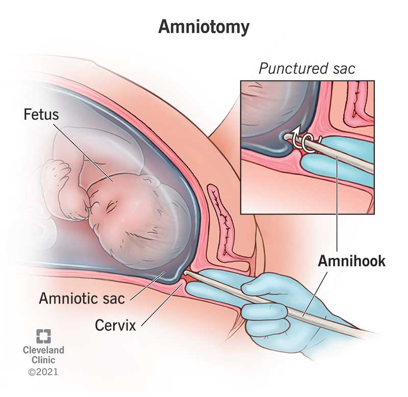 An amnihook inserted through the cervix to rupture the amniotic sac.