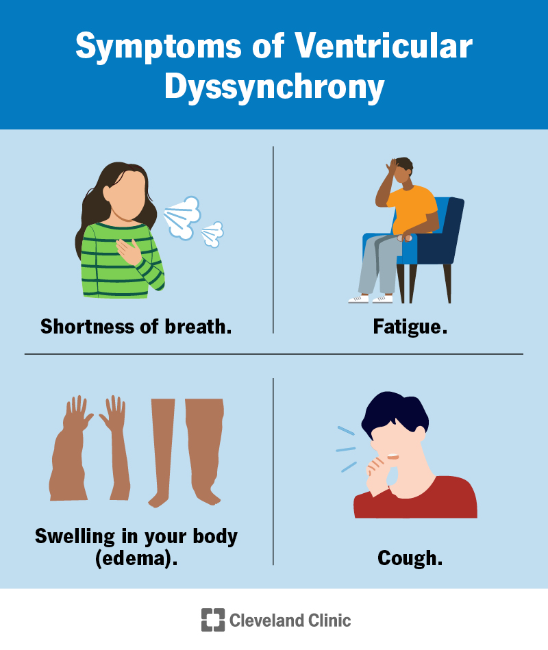 Ventricular dyssynchrony symptoms include fatigue, swelling and shortness of breath.