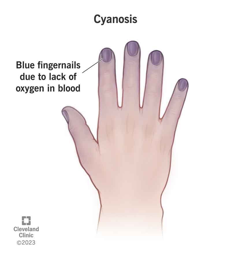 Cyanosis affecting the fingers and nails.
