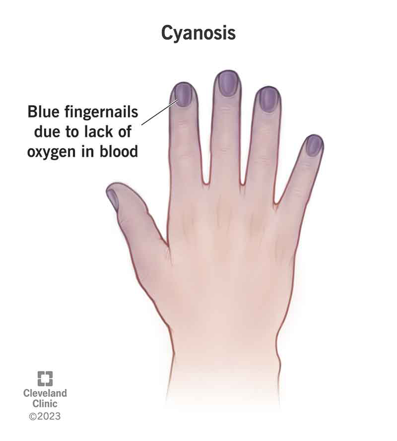 Cyanosis (Blue Hands & Feet): Causes, Treatment & Diagnosis