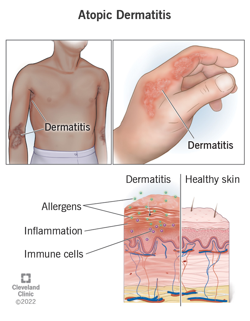 Atopic dermatitis rashes on a person’s hand, arm and side with a skin comparison with and without a rash.