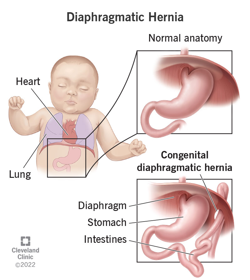An abnormal opening in your baby’s diaphragm allows their organs to pass through it.