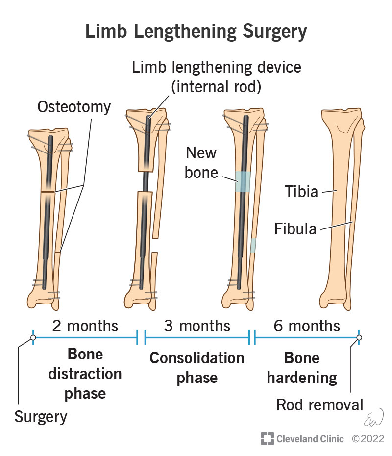 An illustrated timeline of limb lengthening surgery using an internal rod on a tibia and fibula