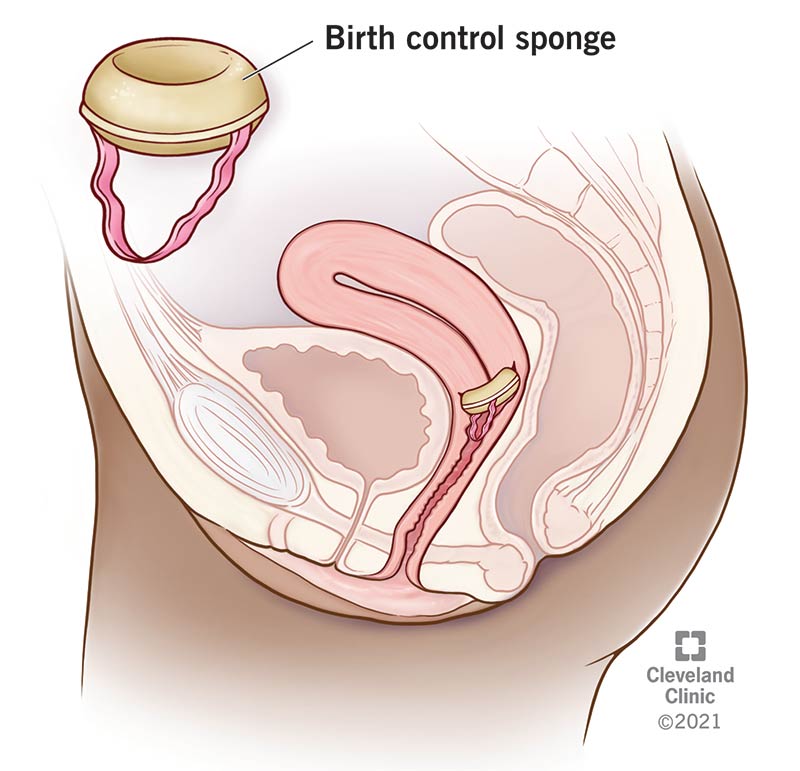 Birth control sponge properly inserted into the vagina.