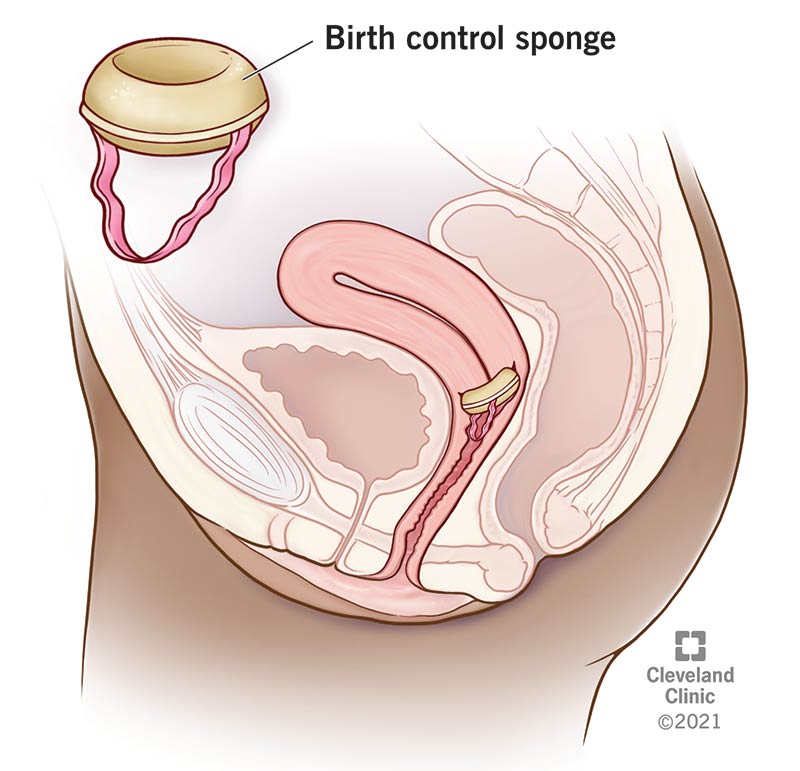 Birth Control Sponge: Effectiveness, & How It Works