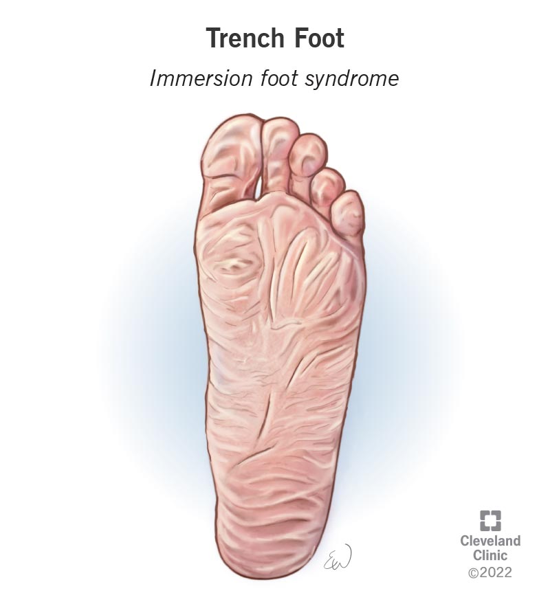 Trench foot, or immersion foot syndrome, can develop when your feet are exposed to a damp, cold environment for a long time.