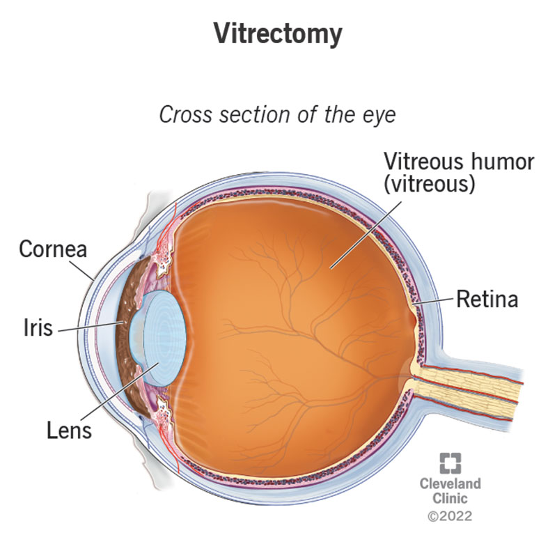 A vitrectomy removes vitreous humor from the eye, which is found in front of the retina but behind the cornea, iris and lens.