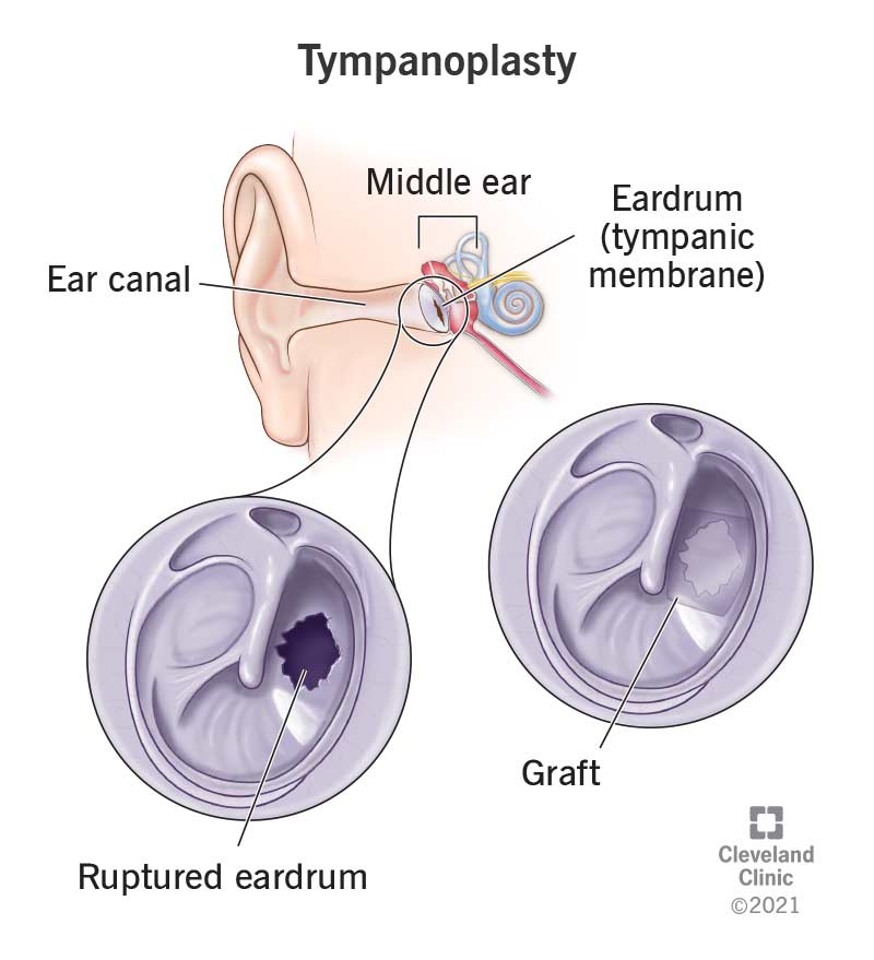 Middle ear, ruptured eardrum, eardrum after tympanoplasty.