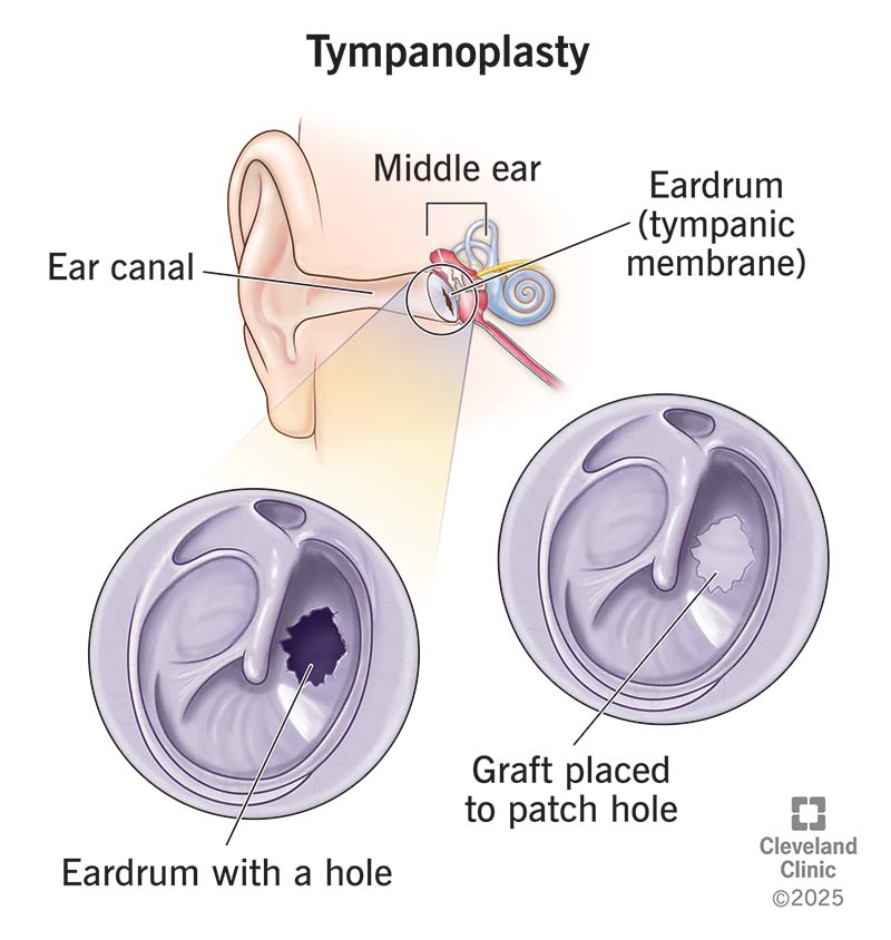 Tympanoplasty Surgery Details Recovery