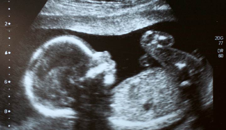 Ultrasound of a fetus inside a uterus.