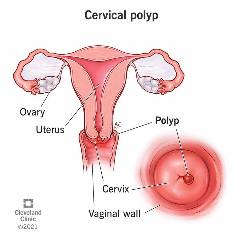 Female reproductive system with a small, red growth (polyp) coming out of the cervix.