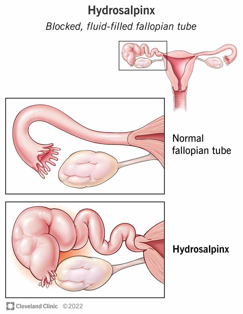 Comparison of a normal, open fallopian tube and a blocked tube with hydrosalpinx