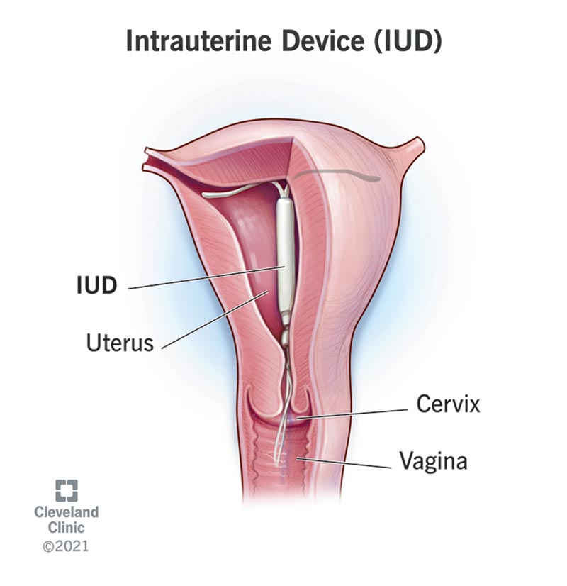 A correctly positioned IUD, with the top part of the T at the top of the uterus and the string extending into the vagina