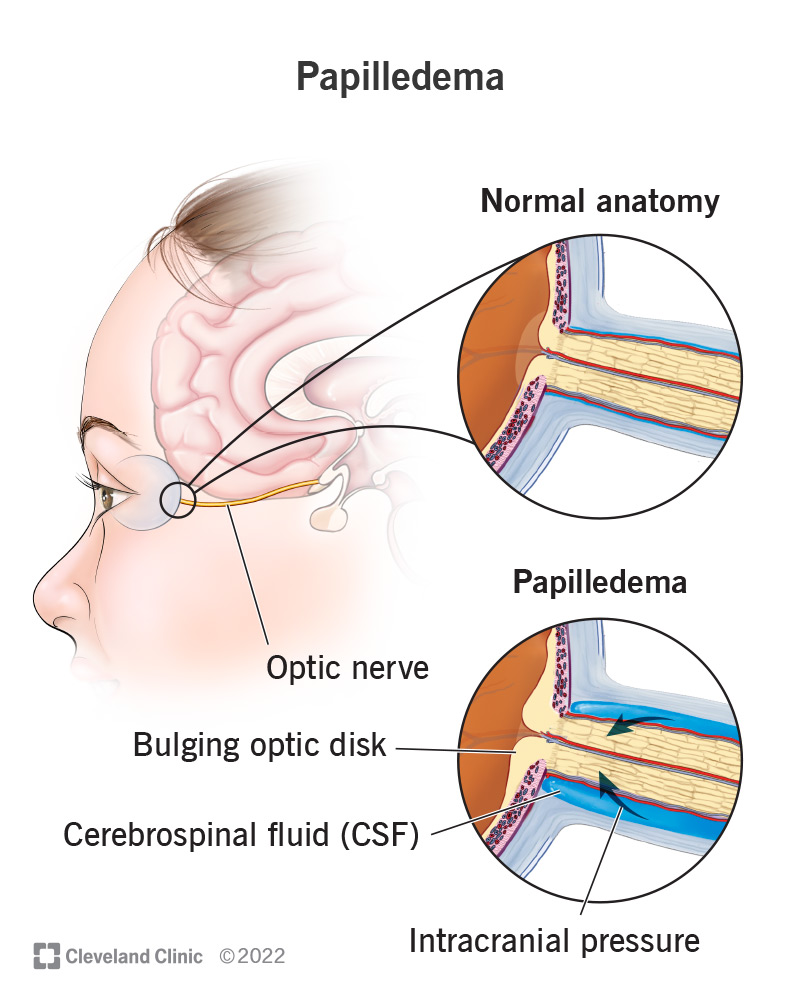 Intracranial pressure from cerebrospinal fluid leads to bulging optic disks in papilledema.