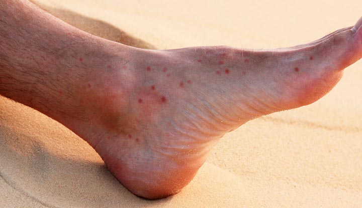 Foot with several sand flea bites.