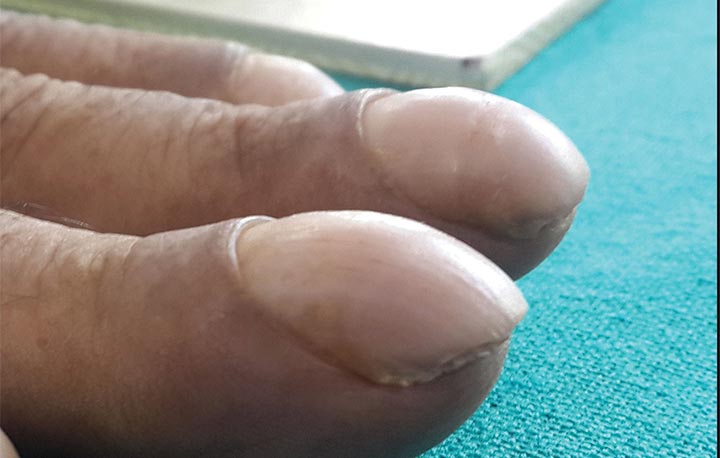 A person’s fingernails with floating nails, a stage of nail clubbing.