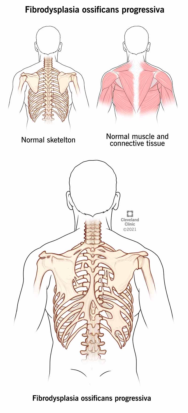 Fibrodysplasia Ossificans Progressiva: Causes, Symptoms, Treatment, Outlook