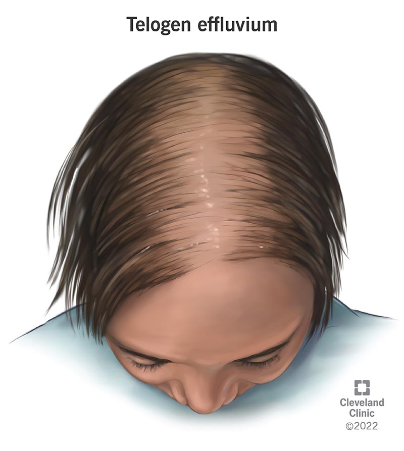 Telogen Effluvium Symptoms Causes Treatment Regrowth