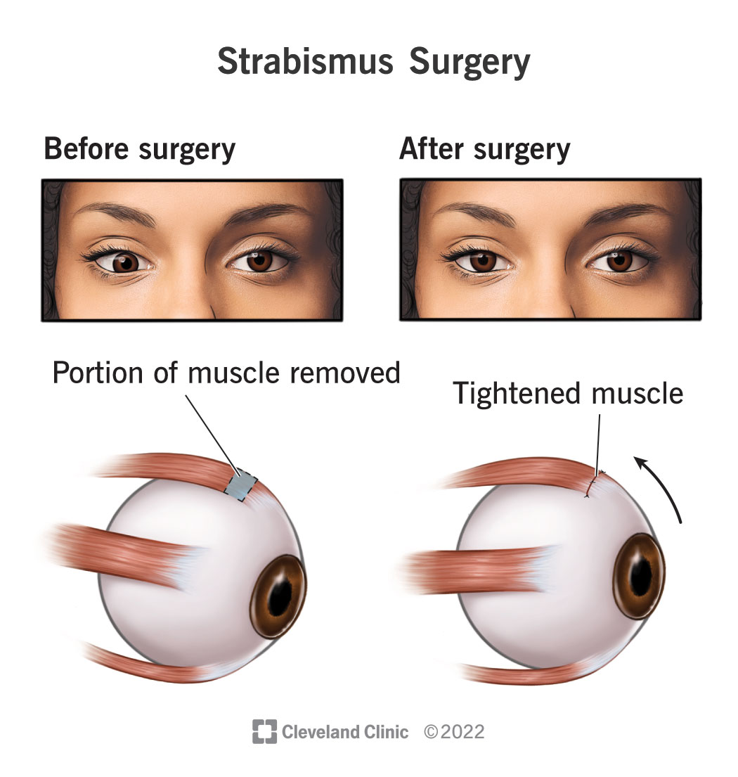 Strabismus surgery can shorten a muscle in your eye and straighten your gaze.