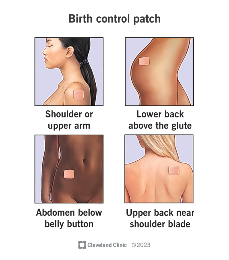 A birth control patch placed on the four parts of your body where you typically wear it.