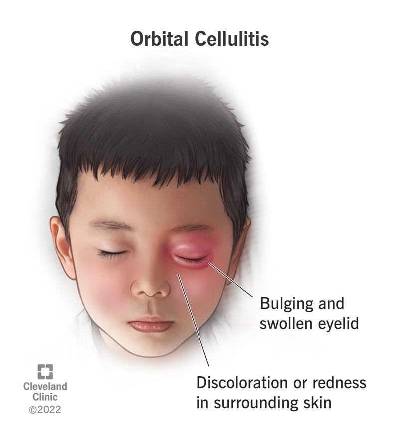 An illustration of orbital cellulitis in the tissue around a child's eye
