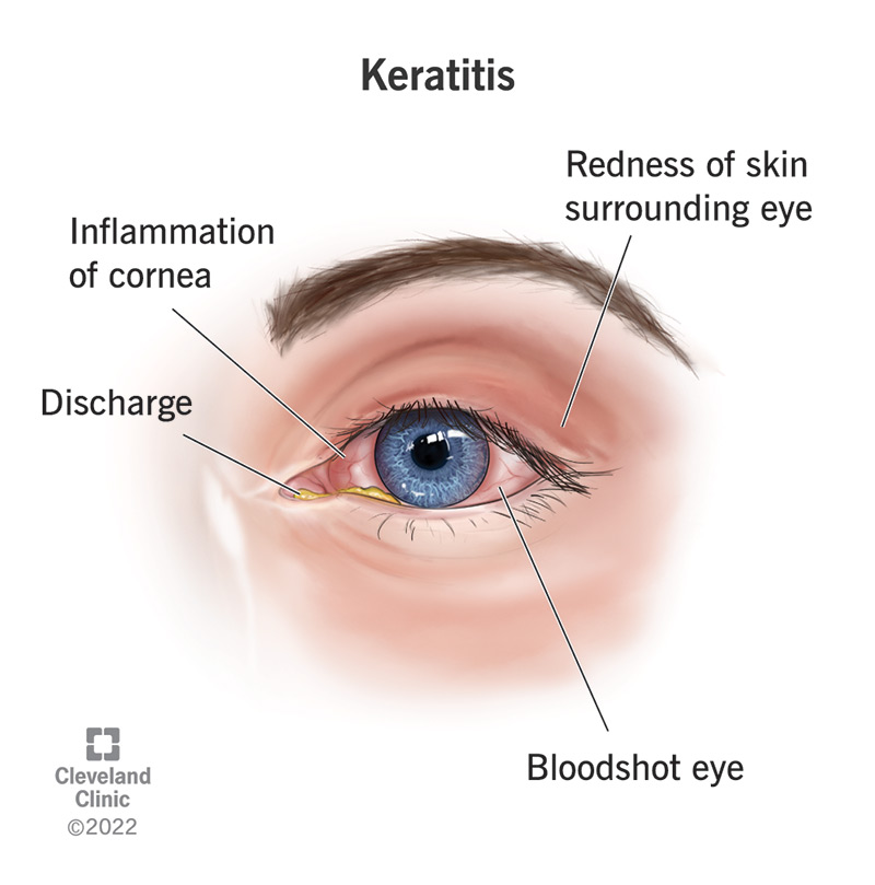 Keratitis, an inflammation of the cornea, can cause discharge, bloodshot eyes and redness or discoloration of the area around the eye.