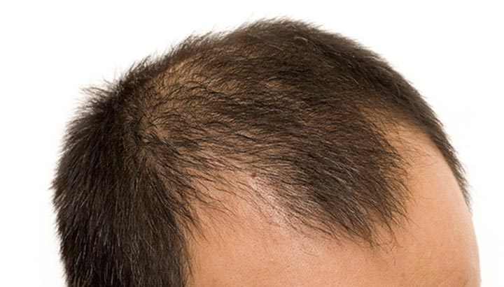 Man with male pattern baldness that is causing hairline recession around the temples and thinning at the top of the head.