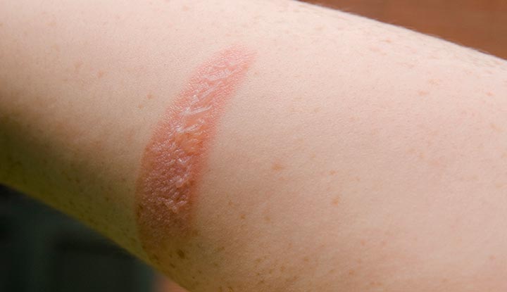 A person’s forearm with a second-degree burn.