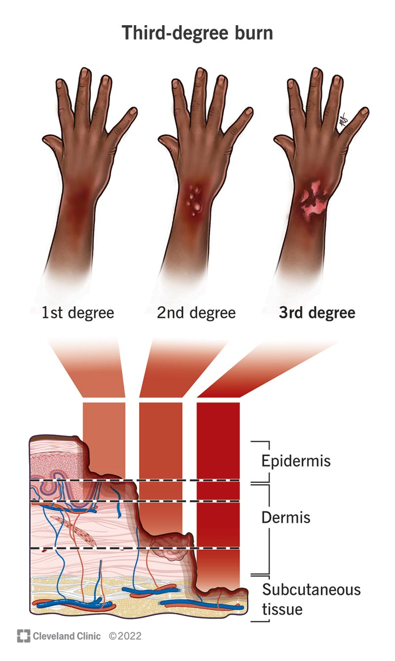 Three hands showing first-, second- and third-degree burns on the wrist and the layers of affected skin.