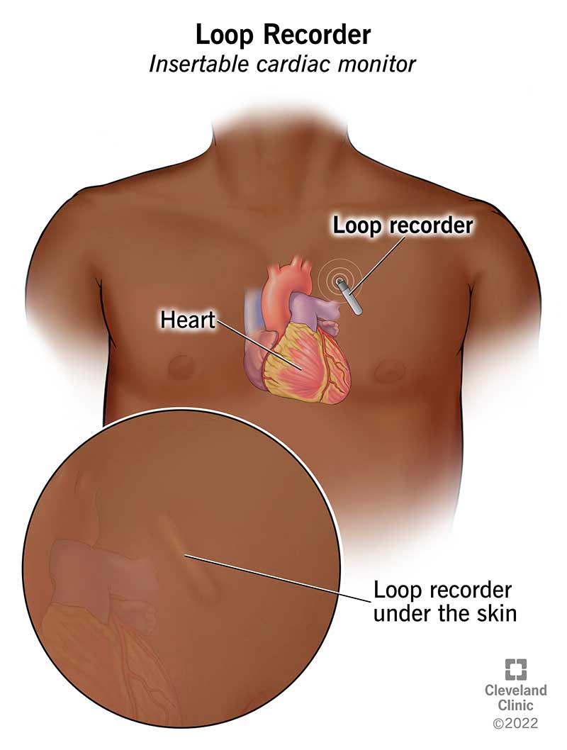The loop recorder is located in your chest. It’s placed just under your skin.