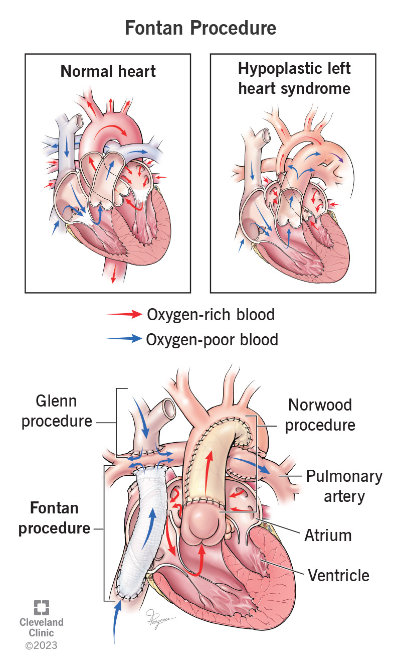 A Fontan procedure allows oxygen-poor blood from the lower body to go to the pulmonary artery, bypassing the heart.