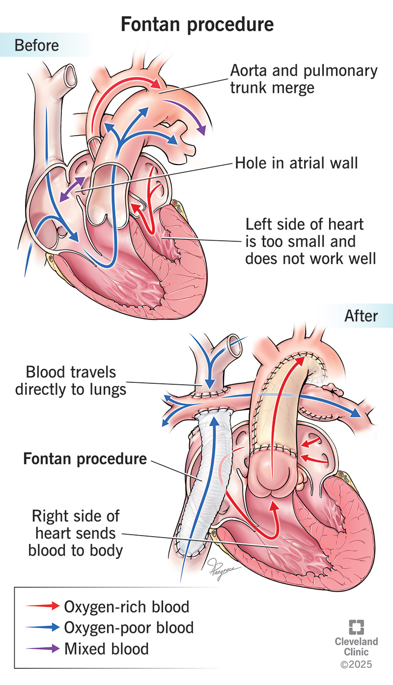 Fontan Procedure Details Outlook