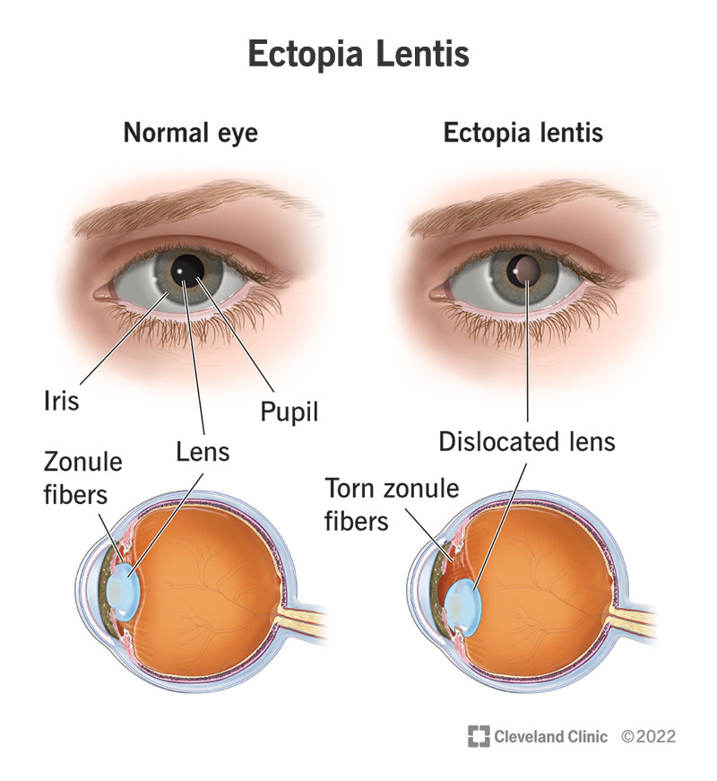 vaak Is Kiezen Ectopia Lentis: What It Is, Causes & Symptoms