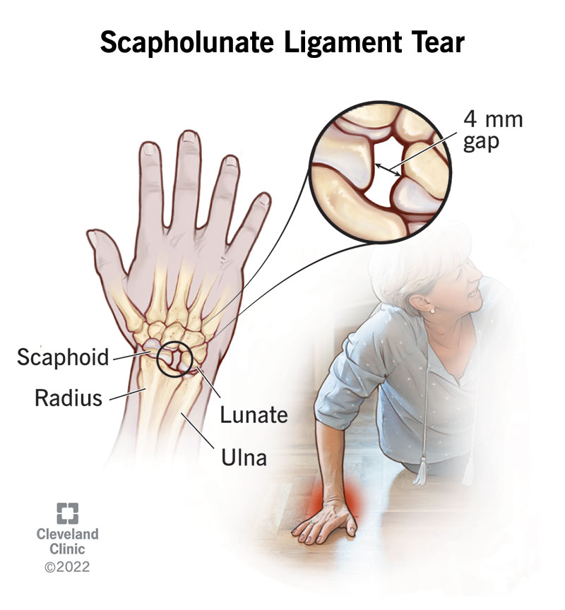 Illustration of sprained wrist ligament