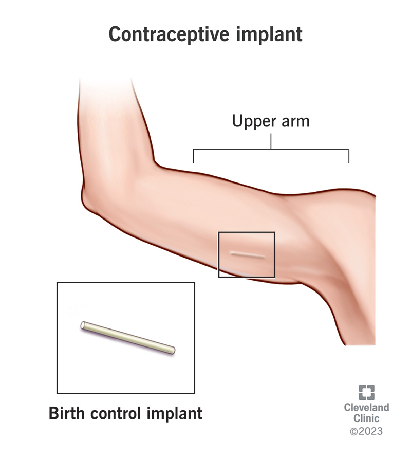 The underside of a person's upper arm showing where a birth control implant goes.