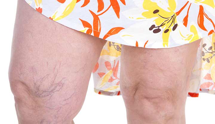 Spider Veins: Can They Go Away on Their Own