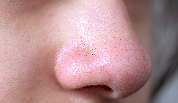 clogged pores bumps