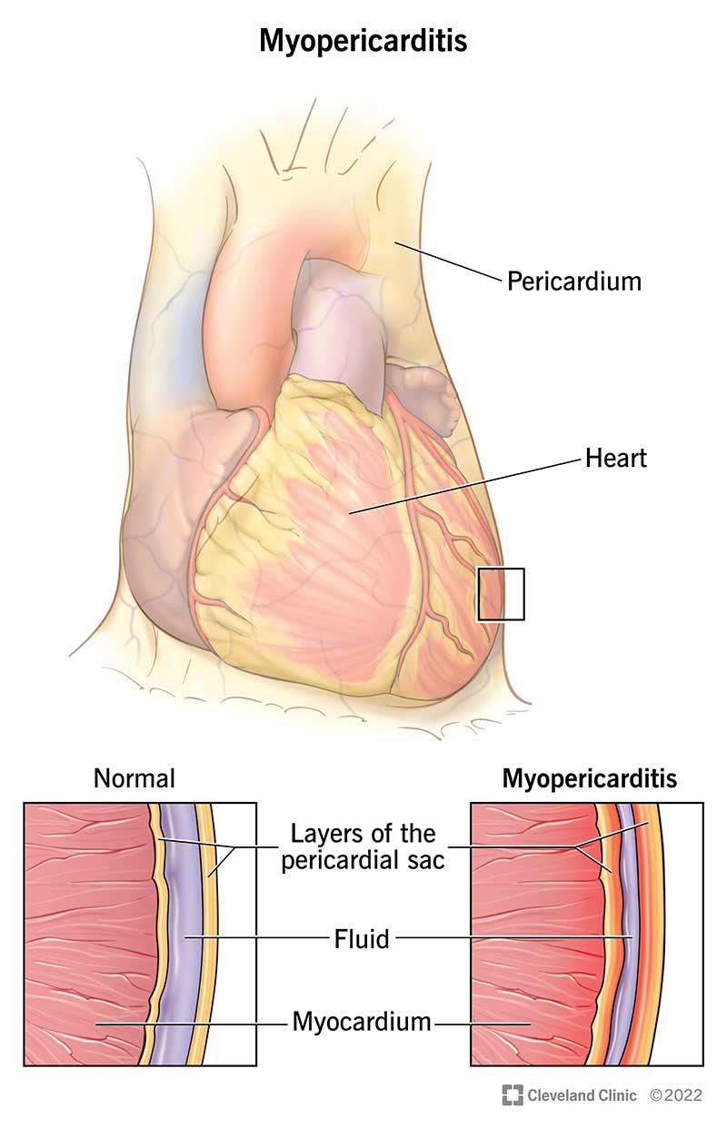 Myopericarditis, or inflammation affecting your pericardium and myocardium.