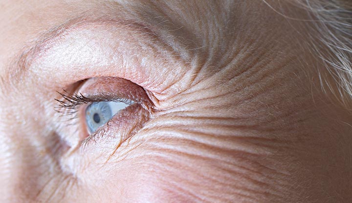 Crow’s feet on a woman’s face.