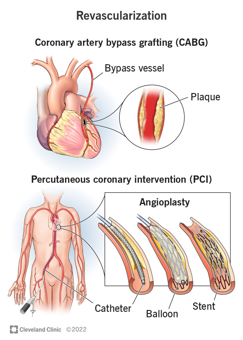 Coronary revascularization treatment restores blood flow to areas of your heart that aren’t getting enough.