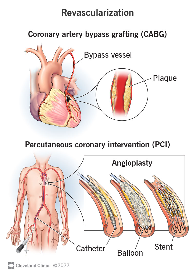 Coronary Revascularization Procedure Details Risks