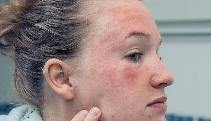 A person with eczema on their face has dry skin and redness on their cheek and forehead.