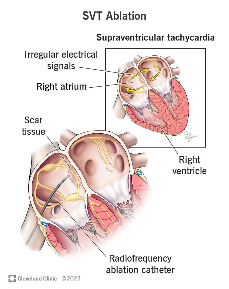 SVT ablation involves using a catheter to create scar tissue that stops irregular signals in your heart.