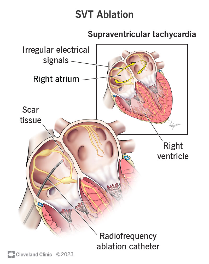 Fast heart rate (tachycardia)