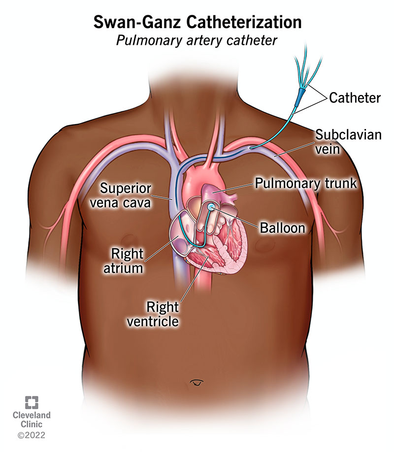 Using a Swan-Ganz catheter to check your heart function