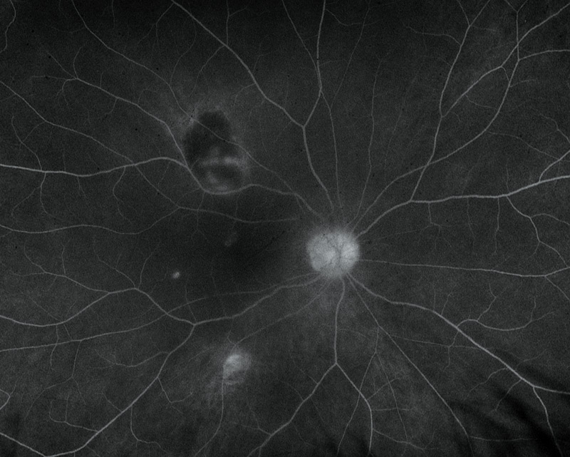 A fluorescein angiography result