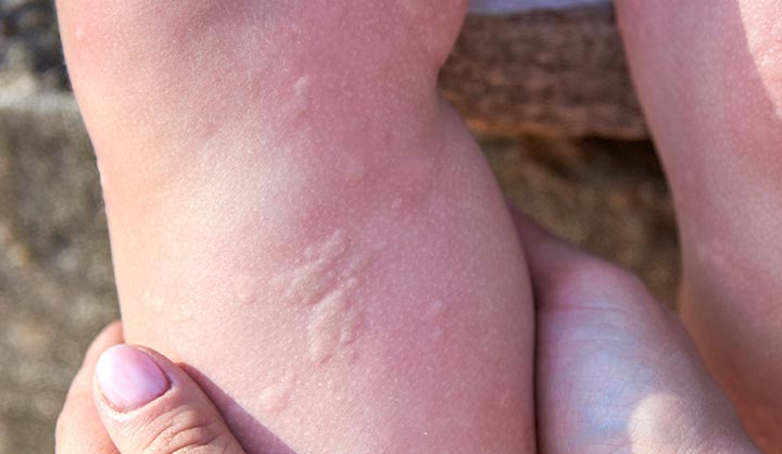 Hives on a person’s skin caused by cold urticaria.