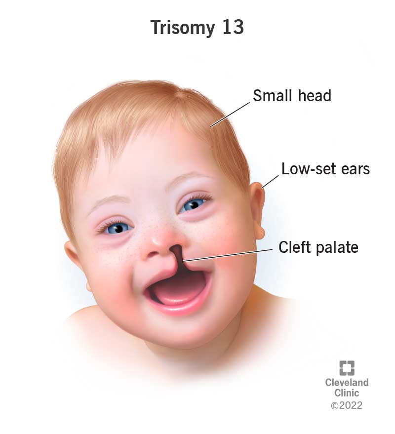 A child diagnosed with trisomy 13 has a small head, low-set ears and a cleft palate.